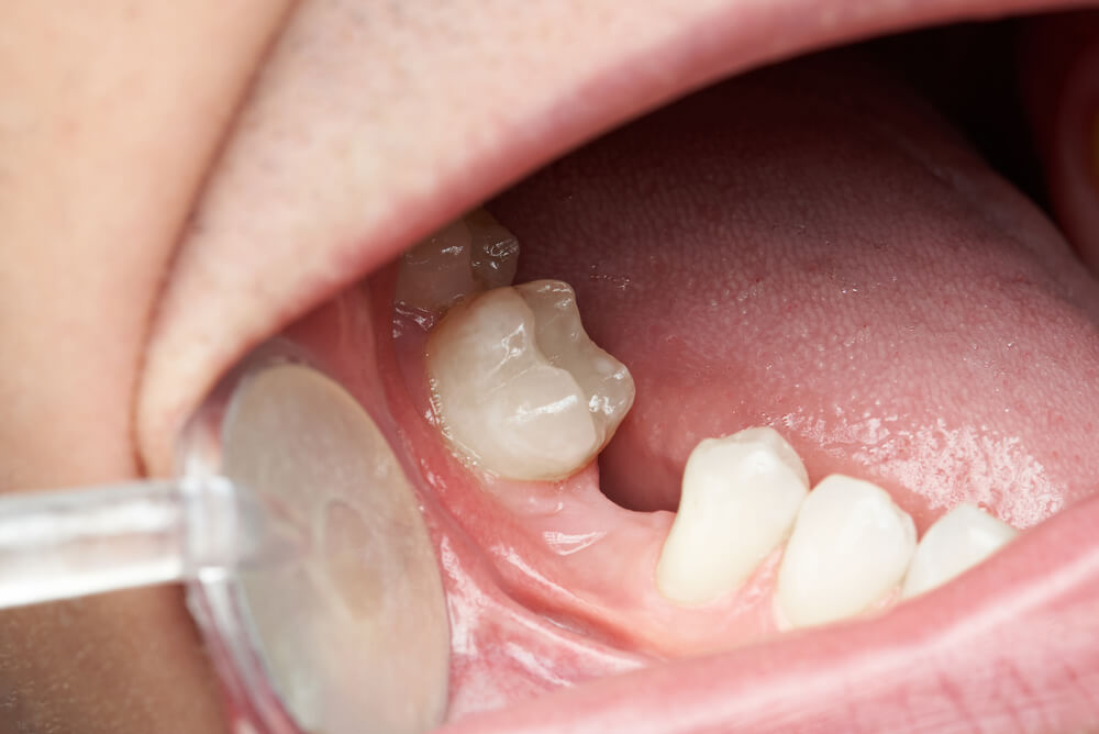 Tooth Replacement inner showing the concept of Tooth Replacement